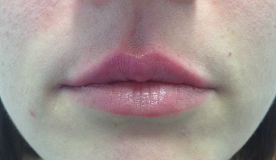 small top lip after filler-484